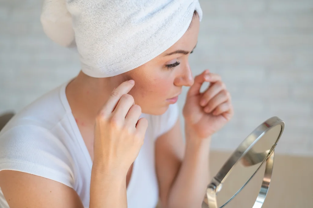 Trądzik androgenny - przyczyny, objawy, leczenie